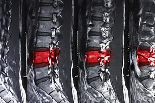 spinal cord injury xray in Cleveland